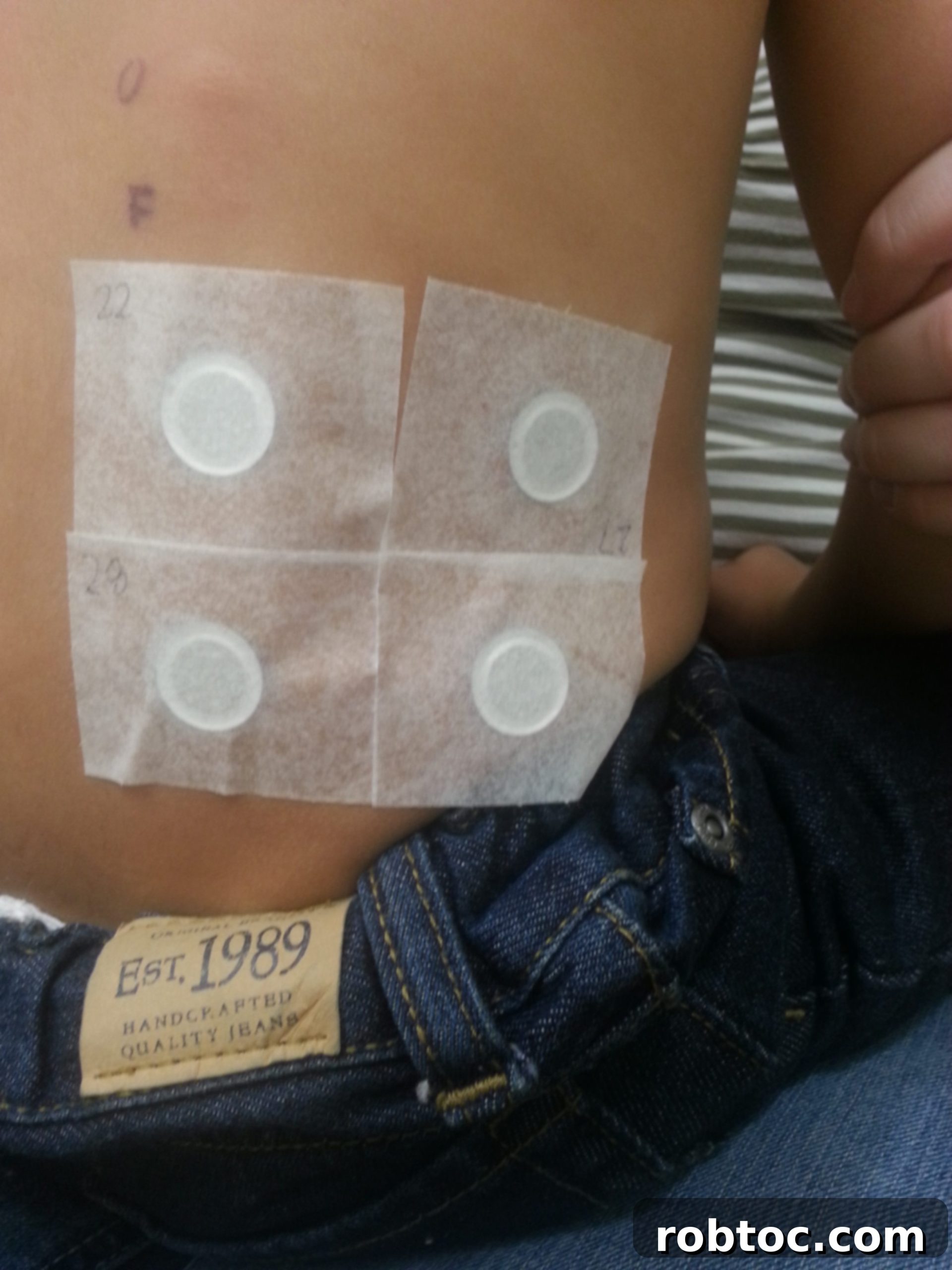 Patch testing for EOE, showing the process of identifying triggers.